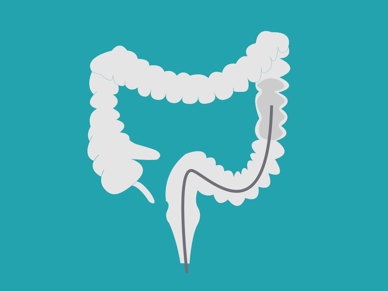 Diagnosis of colorectal cancer